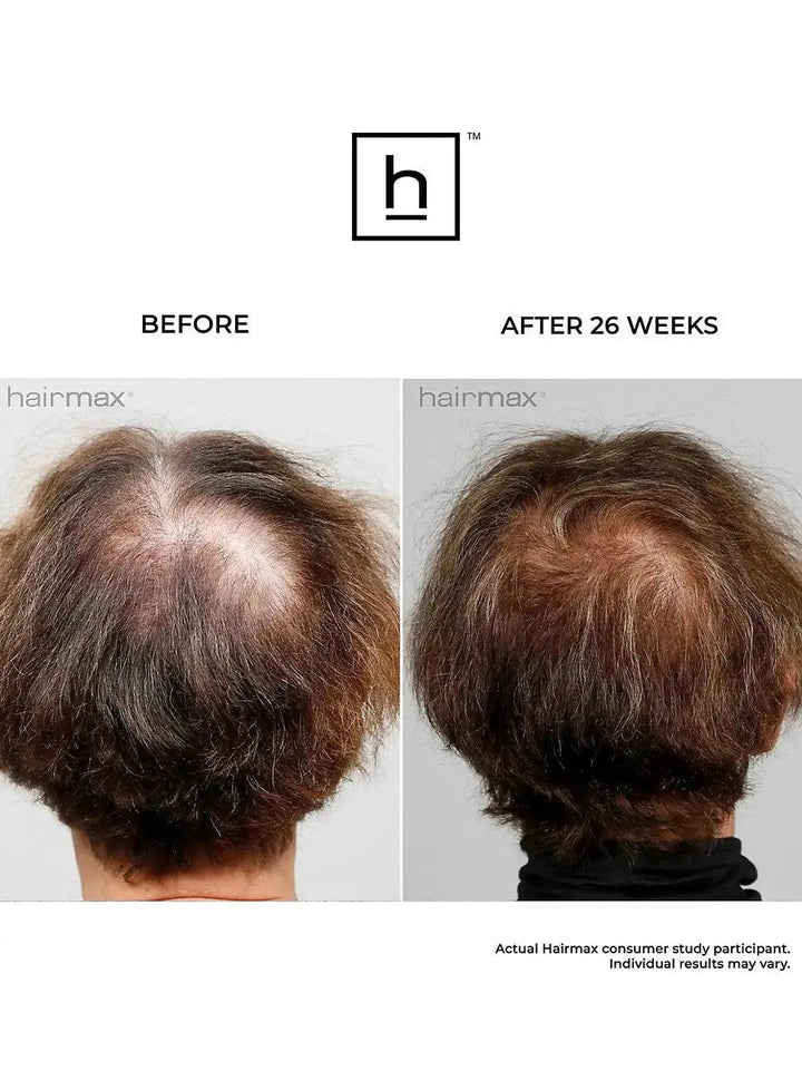 Before and after comparison of hair growth using HairMax Ultima 12 Classic LaserComb at Regrow Hair Center