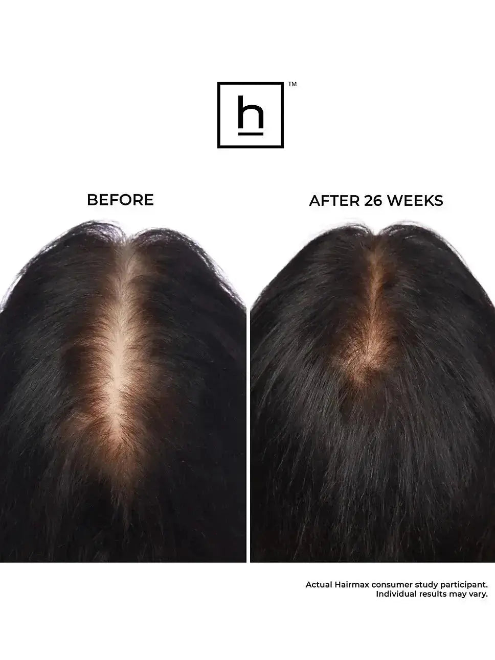 Before and after comparison of hair growth treatment with HairMax Ultima 12 Classic LaserComb
