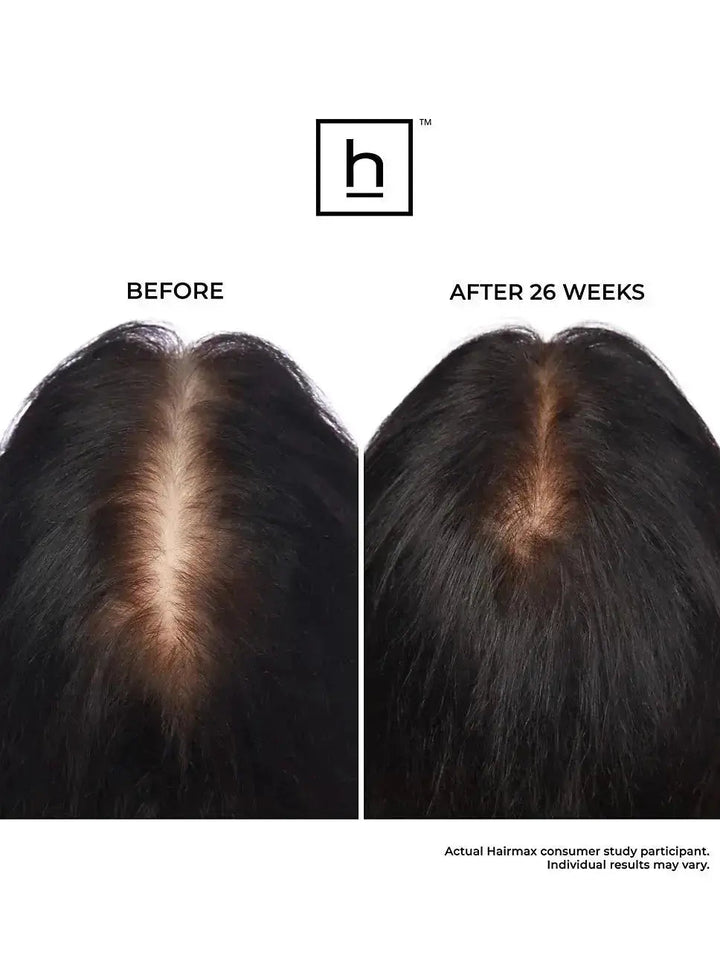 Before and after comparison of hair growth treatment with HairMax Ultima 12 Classic LaserComb