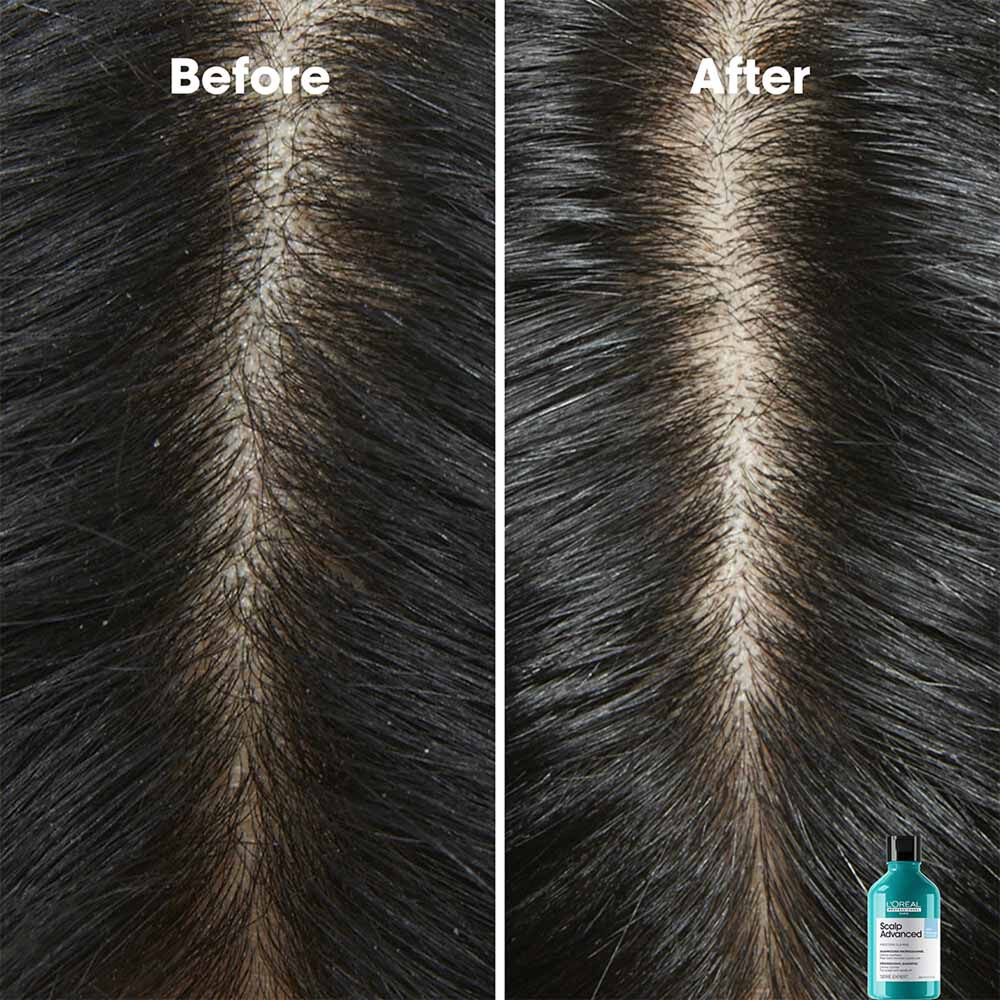 L'Oréal Professionnel Serie Expert Scalp Advanced Anti-Dandruff Dermo Clarifier Shampoo 300ml