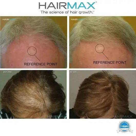 Before and after comparison of hair growth treatment with Hairmax Laser Cap 272